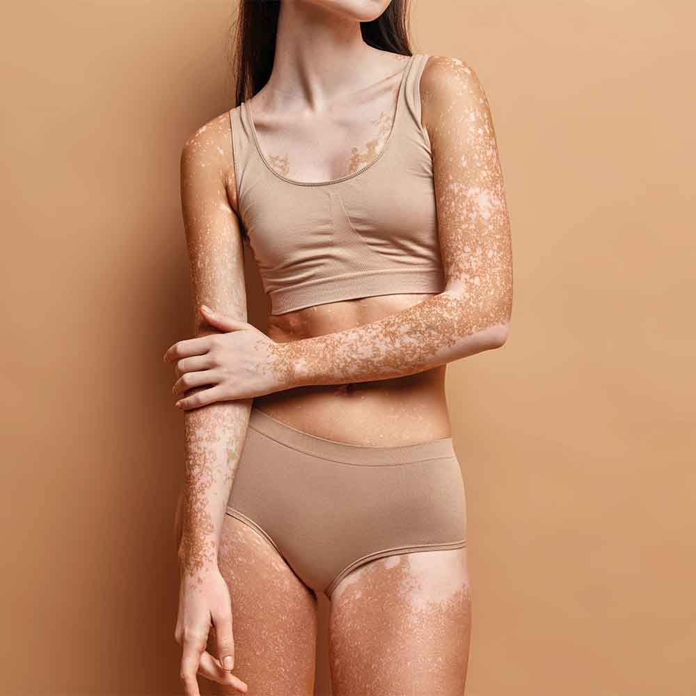 vitiligo